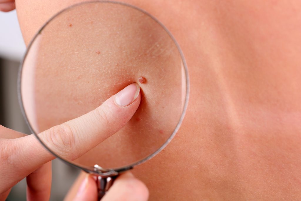 Dermatologist examines a skin tags of patient, close up.