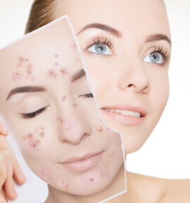 Acne is the most common skin disease in the U.S. that affects all ages & races. Our dermatologist can plan the best acne treatment for you.