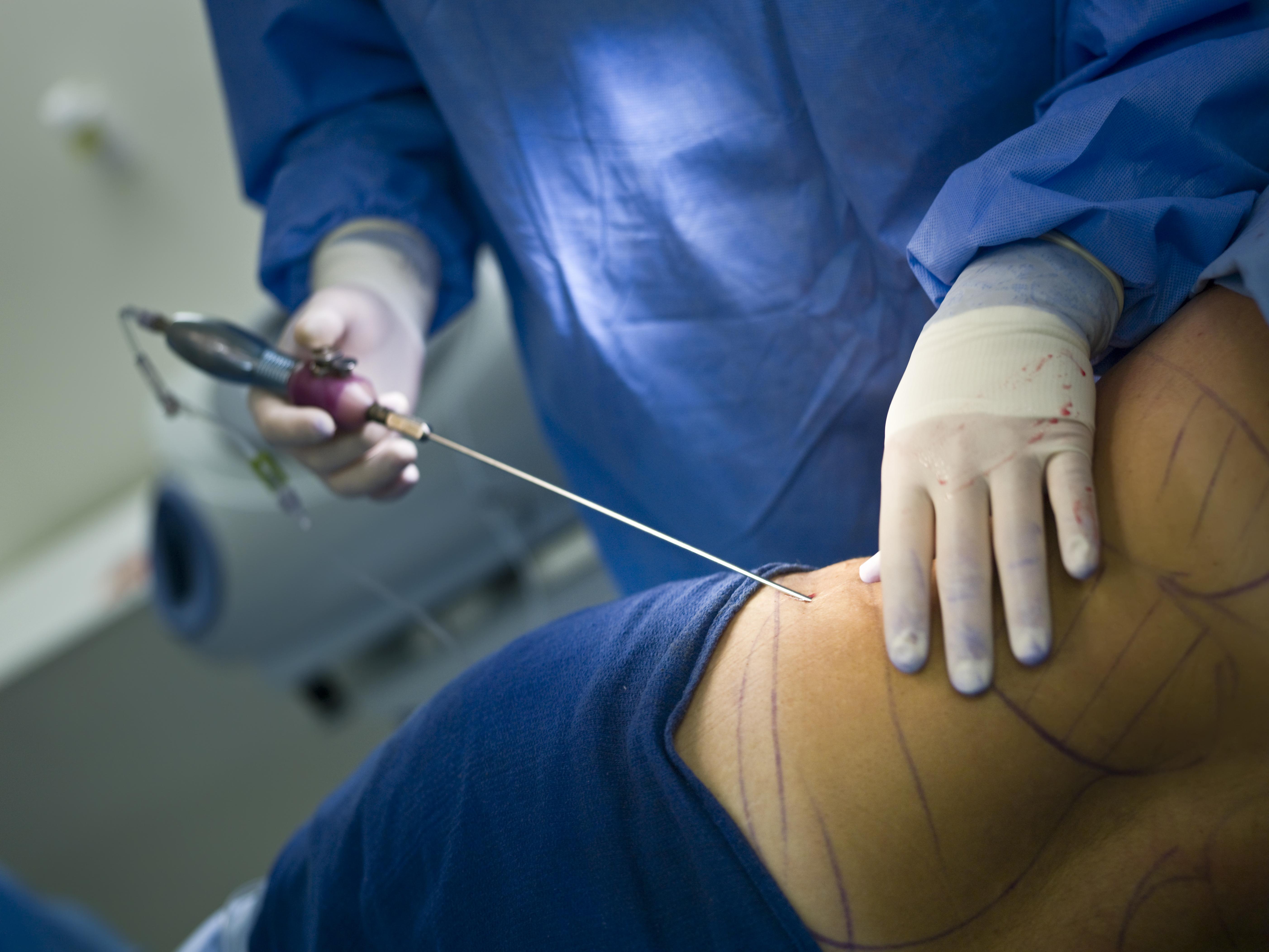 Tumescent Liposuction Experts | U.S. Dermatology Partners