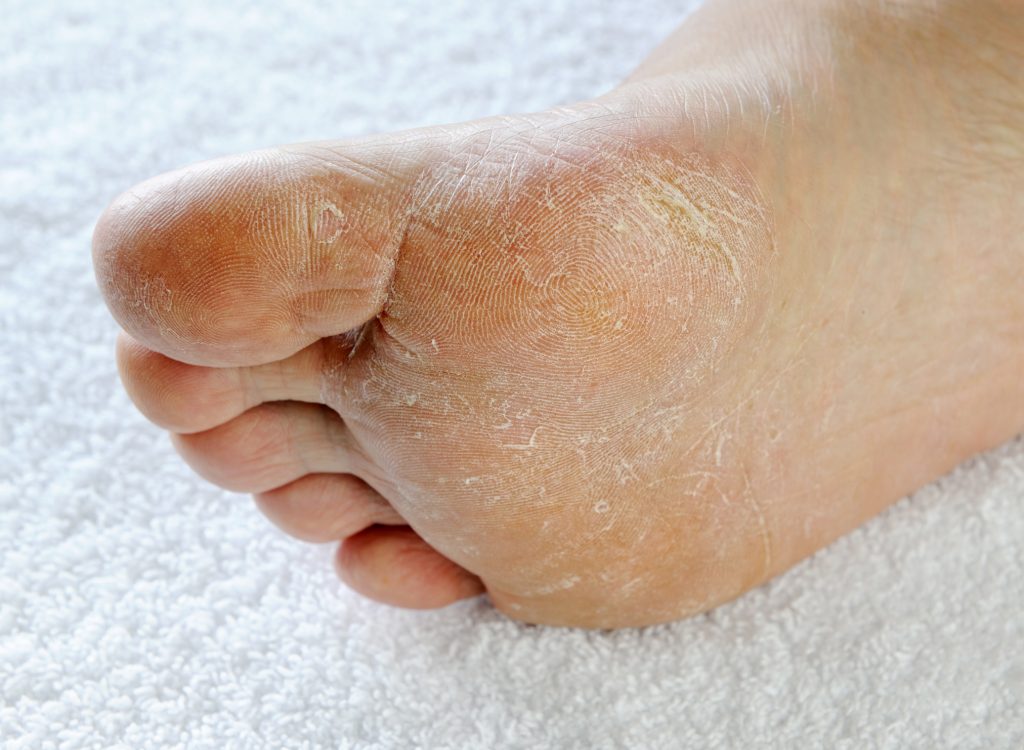 dry itchy skin on bottom of feet