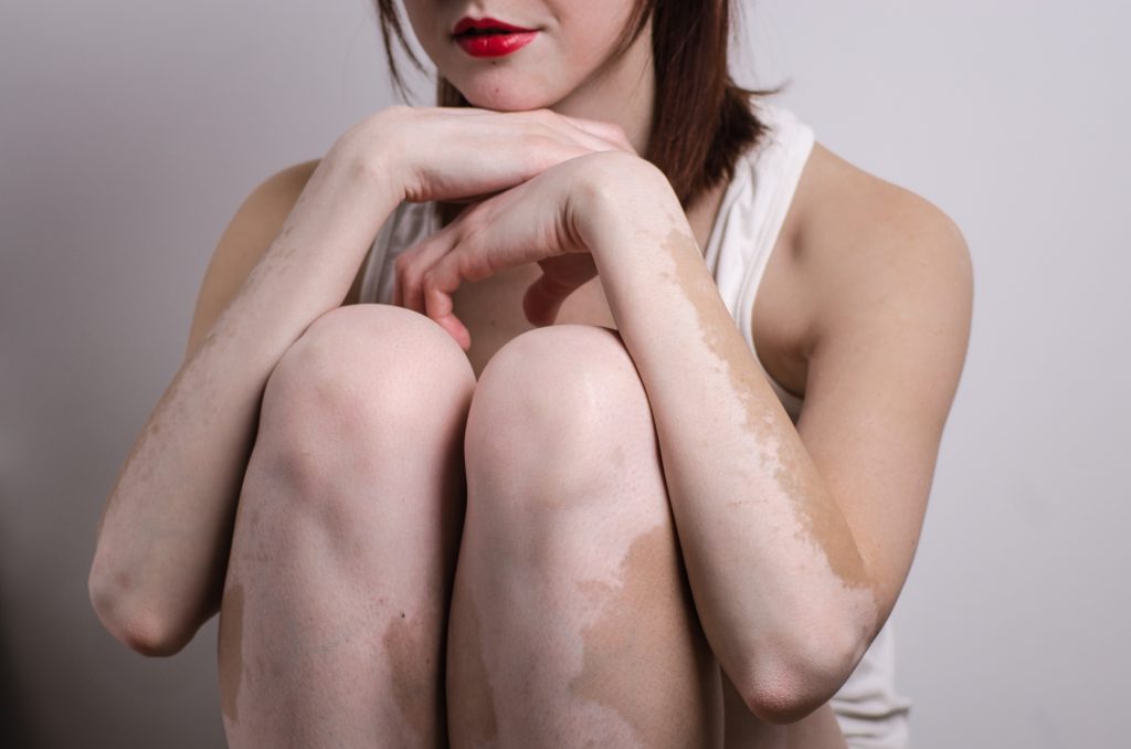 Vitiligo Treatment  U.S. Dermatology Partners