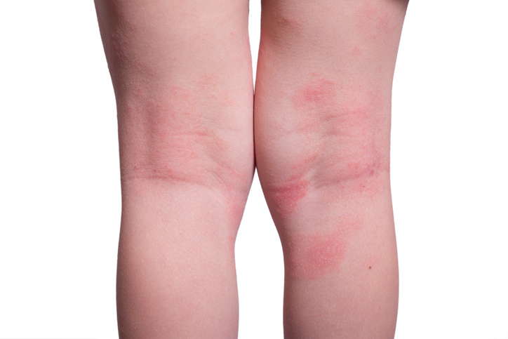 how to treat eczema on elbows