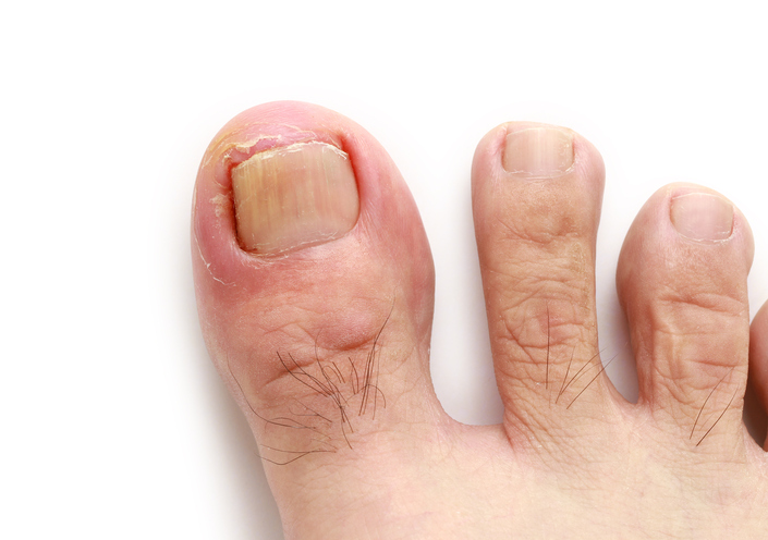 Nail Fungal Infections U S Dermatology Partners