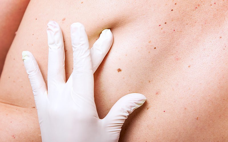 What to Expect During a Full-Body Skin Exam