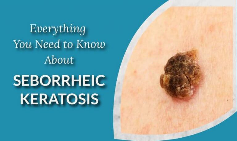 Seborrheic Keratosis 101 Everything You Need To Know