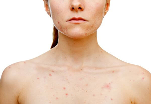 How to Get Rid of Chest Acne - U.S. Dermatology Partners