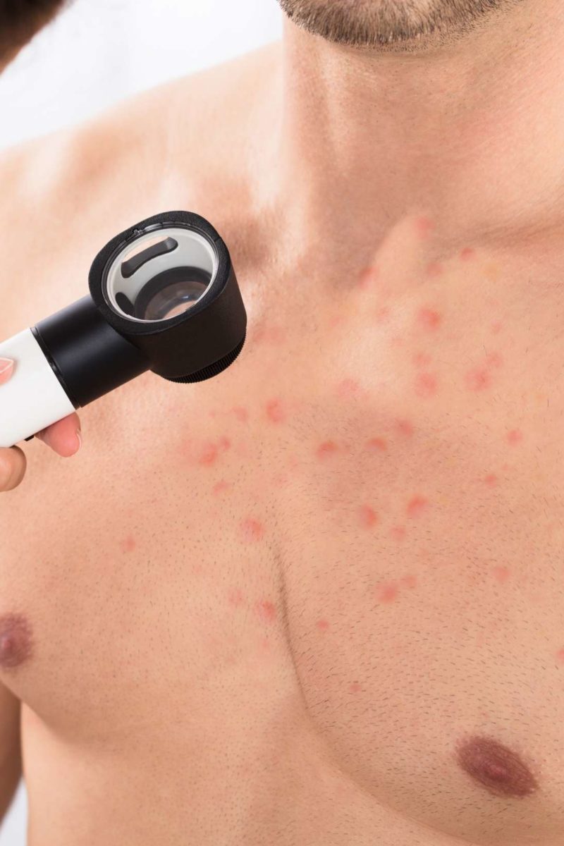 What Causes Chest Acne And How To Get Rid Of It