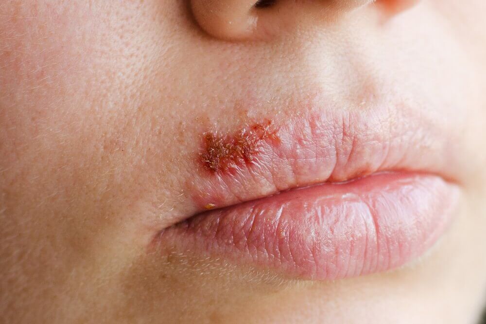 Herpes Simplex Treatment U S Dermatology Partners