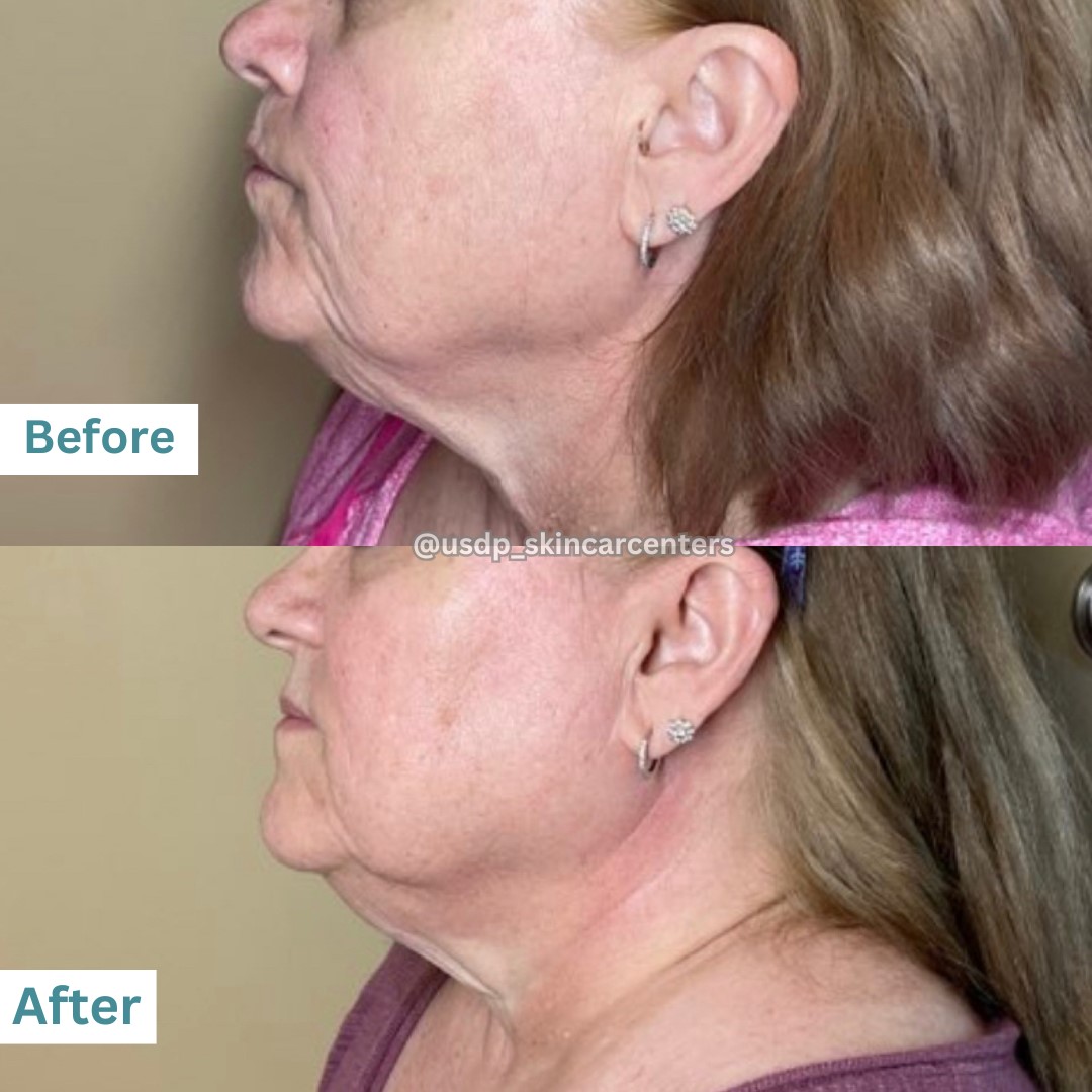 Before and After Image of Vivace RF Microneedling Patient