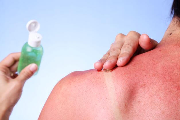 Quick Tips to Heal and Soothe Sunburned Skin