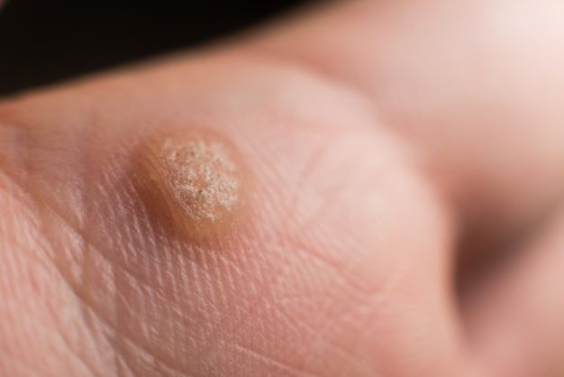 warts on fingers removal