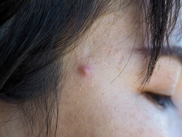 swollen pimple under skin