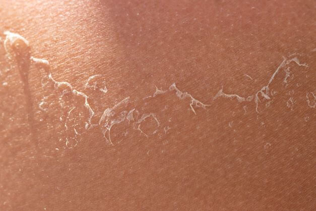 Causes of Scaly or Flaking Skin