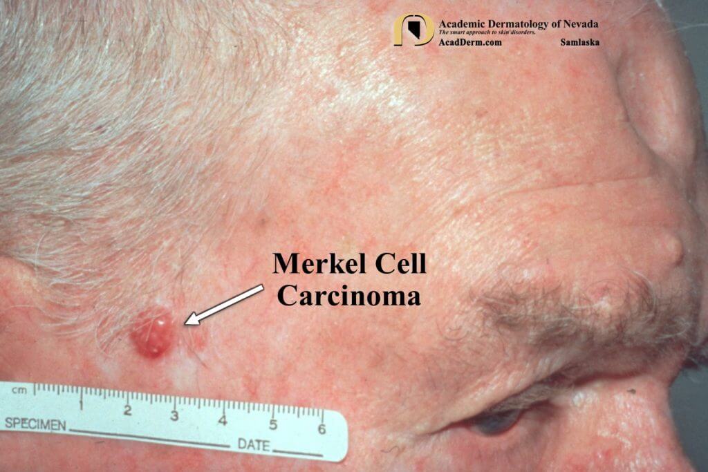 Skin Lesions: Types, Pictures, Diagnosis, Treatment & More