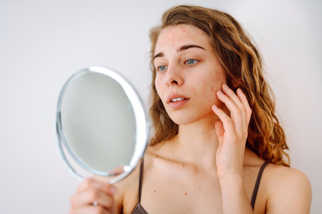 identifying-skin-conditions-that-resemble-acne-a-comprehensive-guide