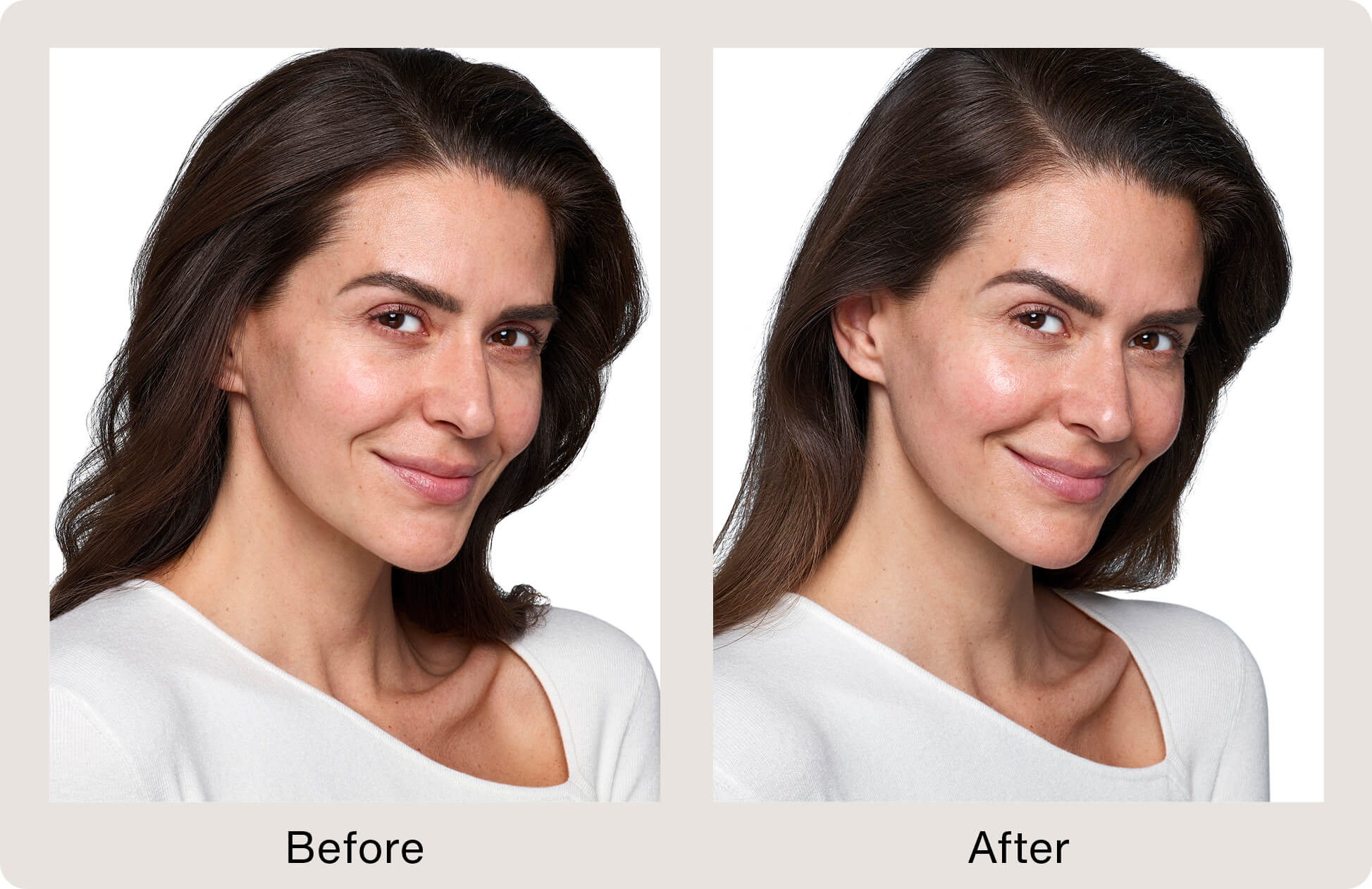 SKINVIVE by JUVÉDERM Before & After Images