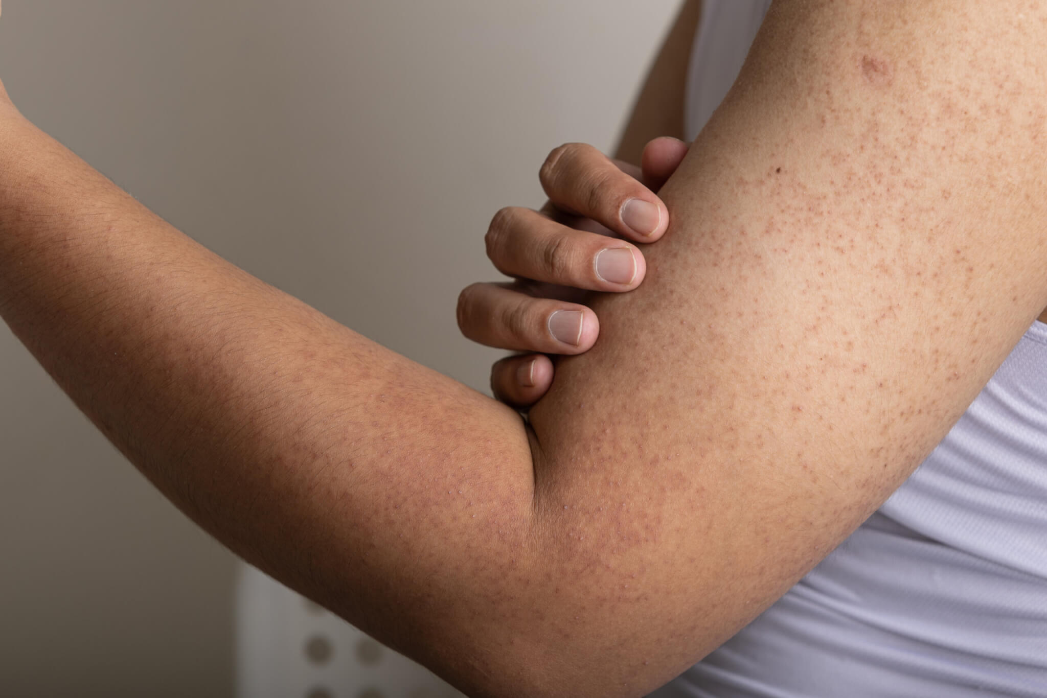 Keratosis Pilaris remedies, managing KP, skincare for bumpy arms, treating chicken skin