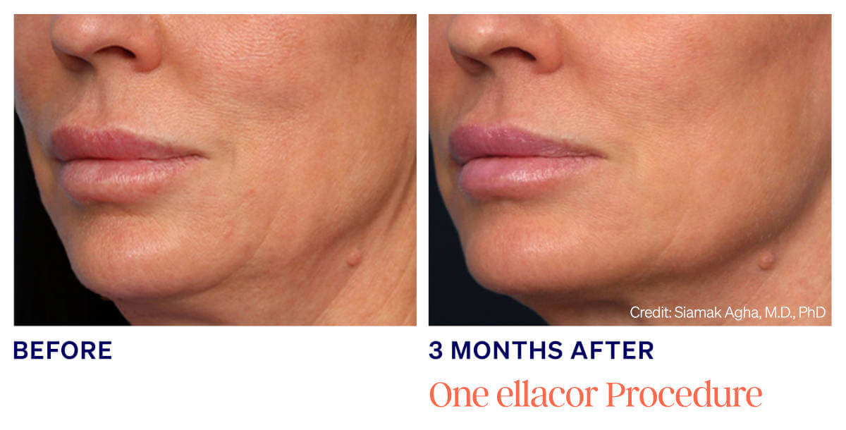 Ellacor treatments utilizes newly developed micro-coring technology to improve the appearance of moderate to severe wrinkles and excess skin.