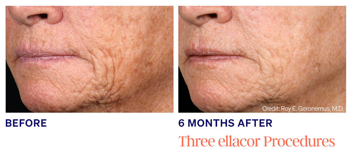 Ellacor treatments utilizes newly developed micro-coring technology to improve the appearance of moderate to severe wrinkles and excess skin.