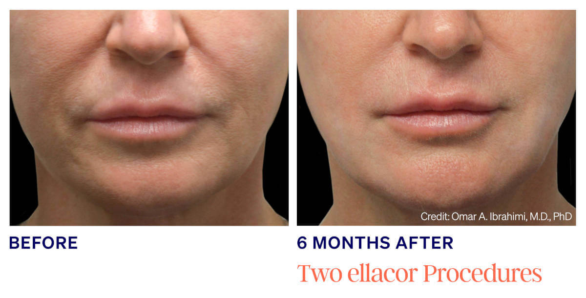 Ellacor treatments utilizes newly developed micro-coring technology to improve the appearance of moderate to severe wrinkles and excess skin.