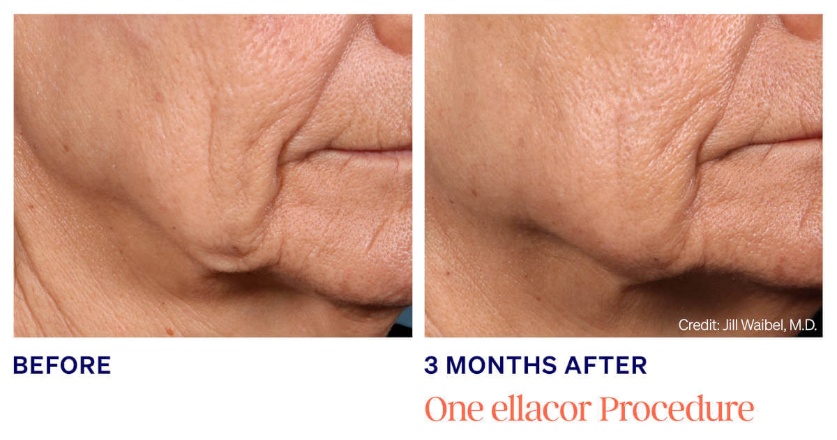 Ellacor treatments utilizes newly developed micro-coring technology to improve the appearance of moderate to severe wrinkles and excess skin.